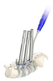  Minimally Invasive Spinal Fixation System