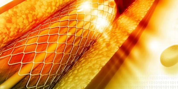 Peripheral Self-Expandable Stent System